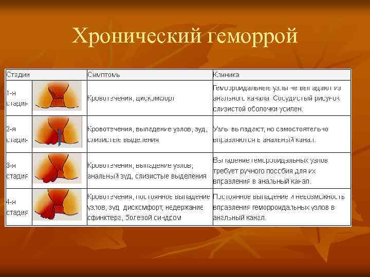 Хронический геморрой 