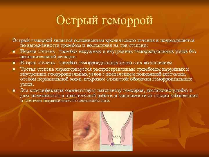Острый геморрой является осложнением хронического течения и подразделяется по выраженности тромбоза и воспаления на