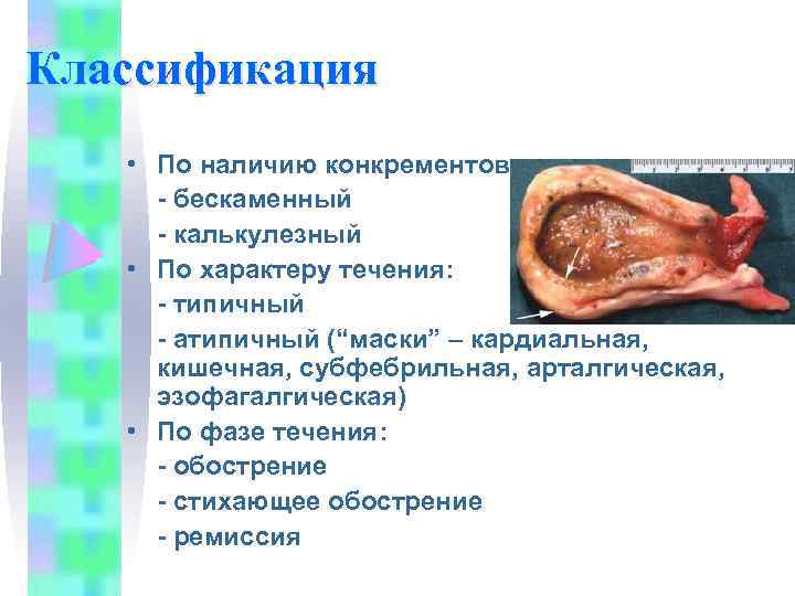 Классификация • По наличию конкрементов: - бескаменный - калькулезный • По характеру течения: -