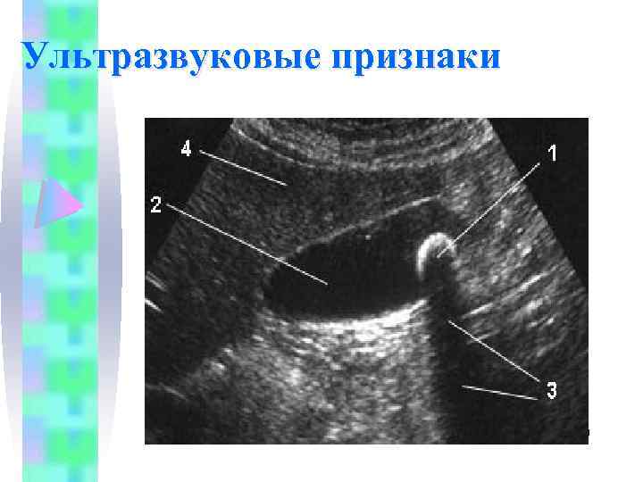 Ультразвуковые признаки 