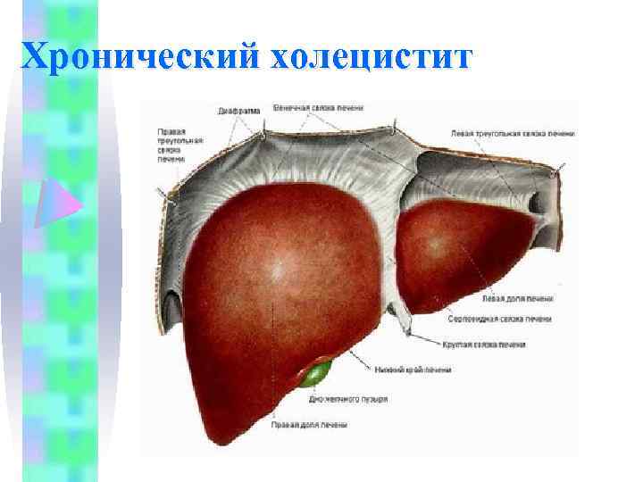 Хронический холецистит картинки