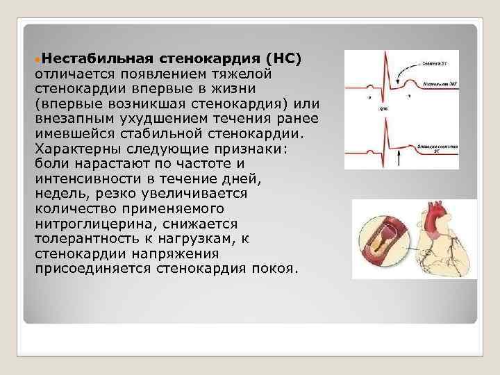 Клиническая картина нестабильной стенокардии