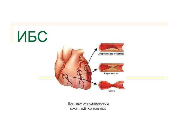 ИБС Доц. каф. фармакологии к. м. н. Е. В. Коноплева 