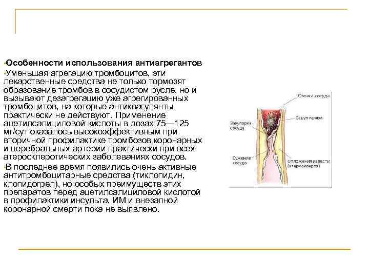  • Особенности использования антиагрегантов • Уменьшая агрегацию тромбоцитов, эти лекарственные средства не только