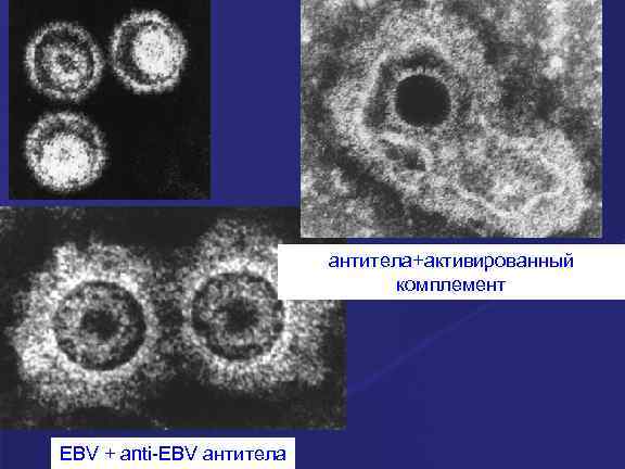 антитела+активированный комплемент EBV + anti-EBV антитела 