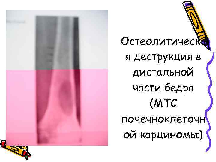 Остеолитическа я деструкция в дистальной части бедра (МТС почечноклеточн ой карциномы) 