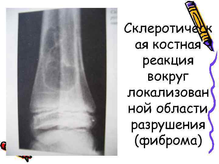 Склеротическ ая костная реакция вокруг локализован ной области разрушения (фиброма) 