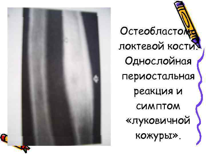 Остеобластома локтевой кости. Однослойная периостальная реакция и симптом «луковичной кожуры» . 