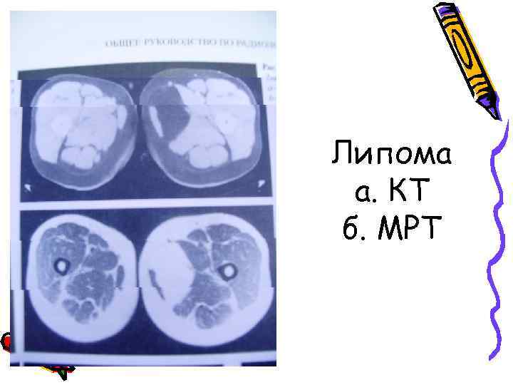 Липома а. КТ б. МРТ 
