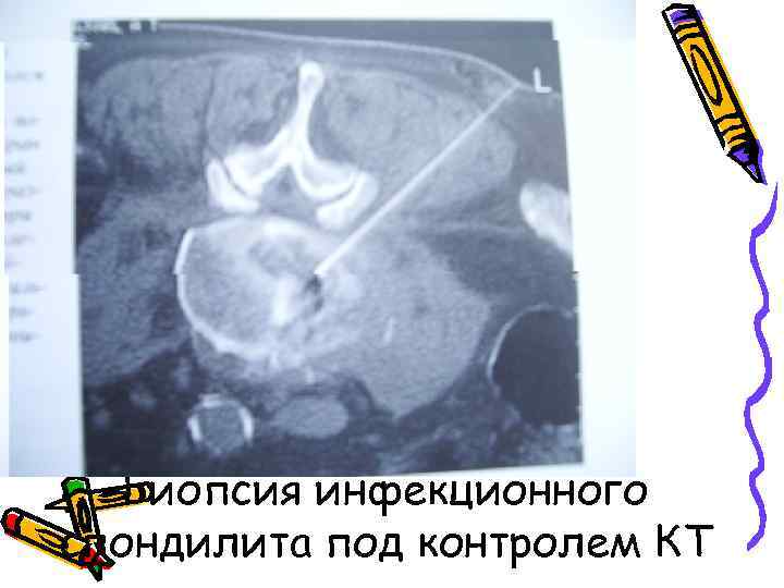 Биопсия инфекционного спондилита под контролем КТ 