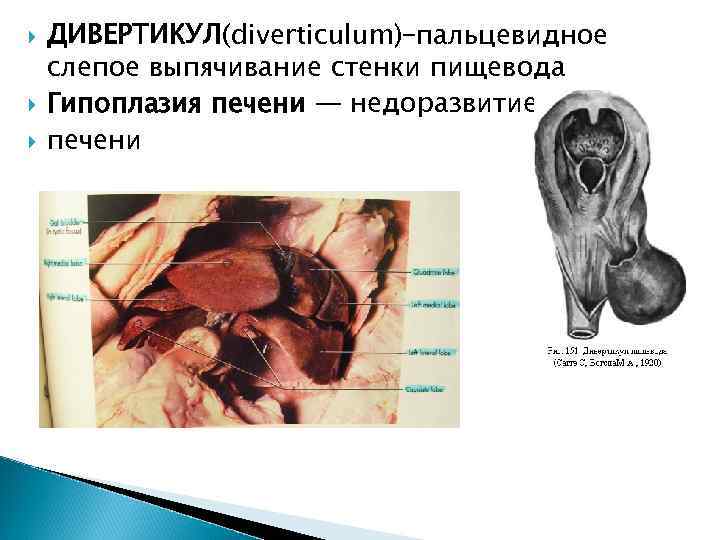  ДИВЕРТИКУЛ(diverticulum)–пальцевидное слепое выпячивание стенки пищевода Гипоплазия печени — недоразвитие печени 