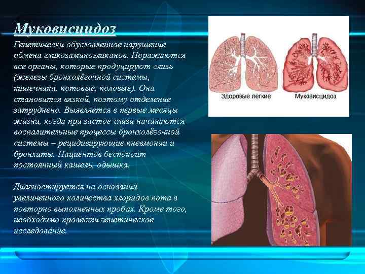 Муковисцидоз Генетически обусловленное нарушение обмена гликозаминогликанов. Поражаются все органы, которые продуцируют слизь (железы бронхолёгочной