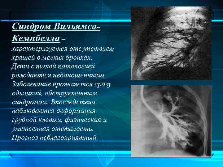 Синдром Вильямса. Кемпбелла – характеризуется отсутствием хрящей в мелких бронхах. Дети с такой патологией