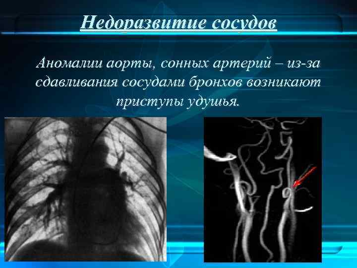 Недоразвитие сосудов Аномалии аорты, сонных артерий – из-за сдавливания сосудами бронхов возникают приступы удушья.