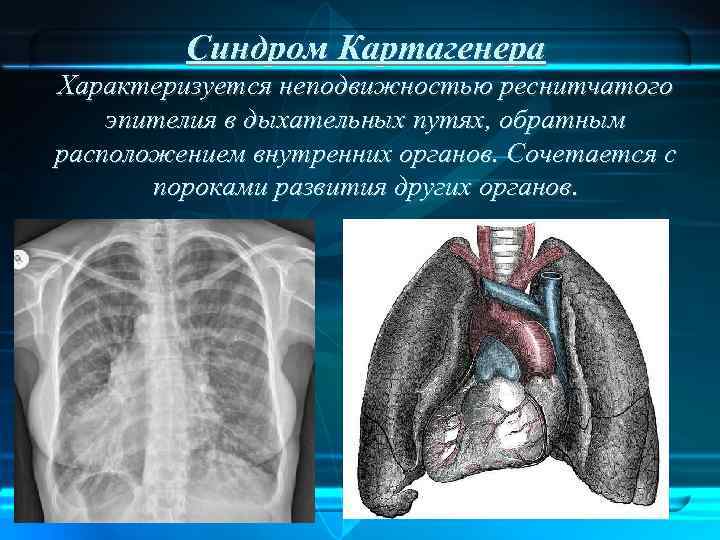 Синдром Картагенера Характеризуется неподвижностью реснитчатого эпителия в дыхательных путях, обратным расположением внутренних органов. Сочетается