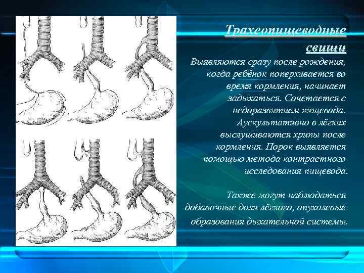 Трахеопищеводные свищи Выявляются сразу после рождения, когда ребёнок поперхивается во время кормления, начинает задыхаться.