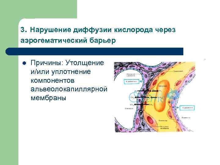 3. Нарушение диффузии кислорода через аэрогематический барьер l Причины: Утолщение и/или уплотнение компонентов альвеолокапиллярной