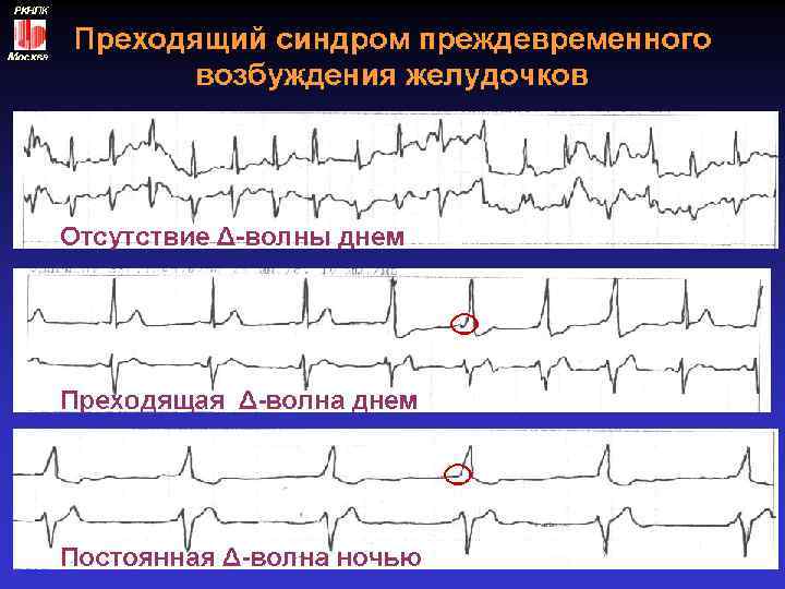 Нарушение ритма сердца презентация