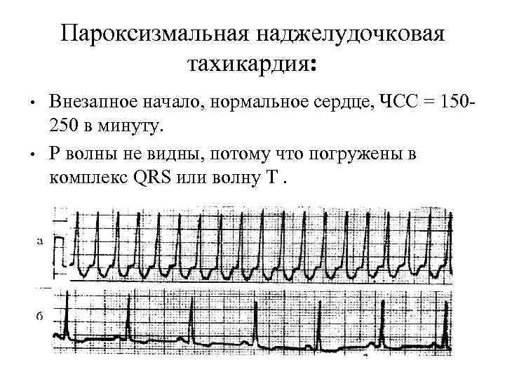 Пароксизмальная наджелудочковая тахикардия: • • Внезапное начало, нормальное сердце, ЧСС = 150250 в минуту.