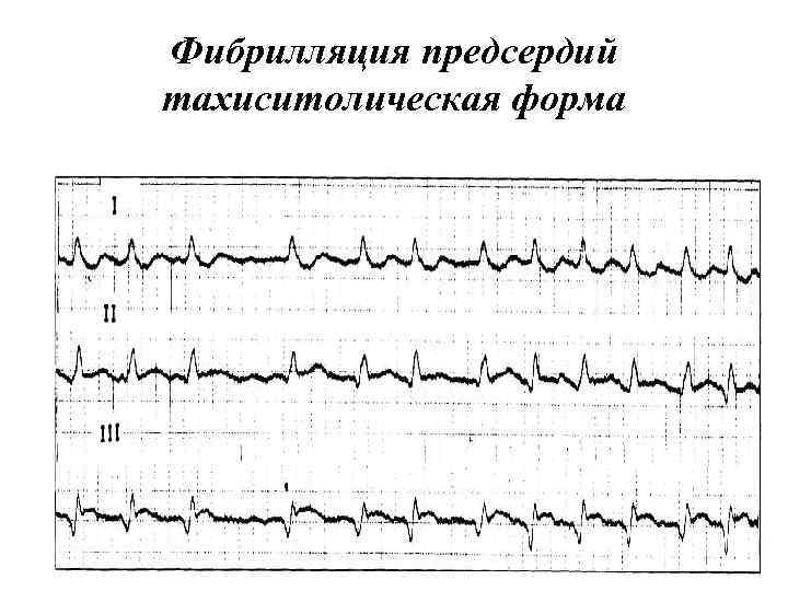Фибрилляция предсердий тахиситолическая форма 