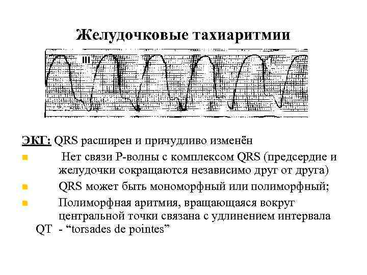 Желудочковые тахиаритмии ЭКГ: QRS расширен и причудливо изменён Нет связи Р-волны с комплексом QRS