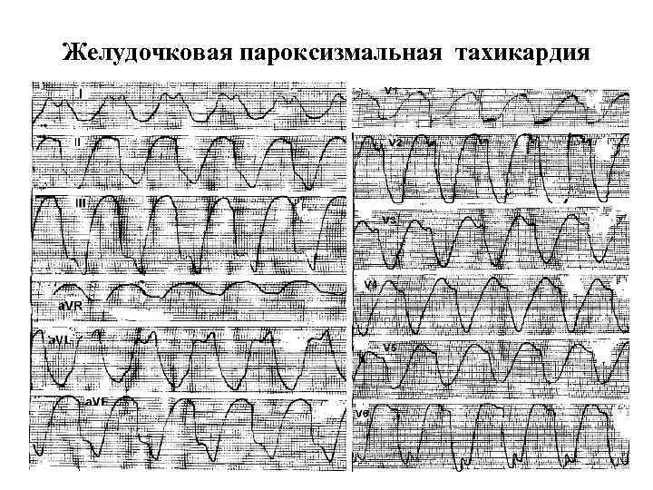 Желудочковая пароксизмальная тахикардия 