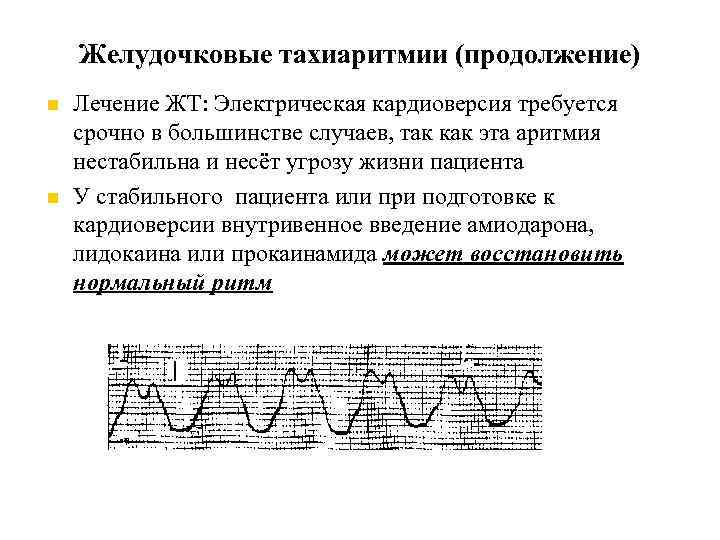 Желудочковые тахиаритмии (продолжение) Лечение ЖТ: Электрическая кардиоверсия требуется срочно в большинстве случаев, так как