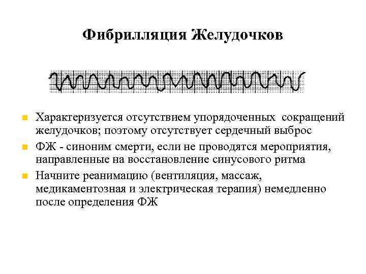 Фибрилляция Желудочков Характеризуется отсутствием упорядоченных сокращений желудочков; поэтому отсутствует сердечный выброс ФЖ - синоним