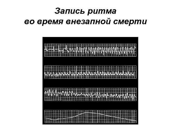 Запись ритма во время внезапной смерти 