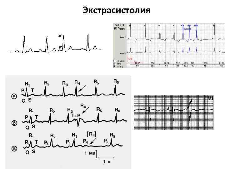Экстрасистолия 