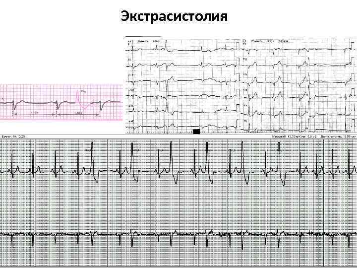 Экстрасистолия 