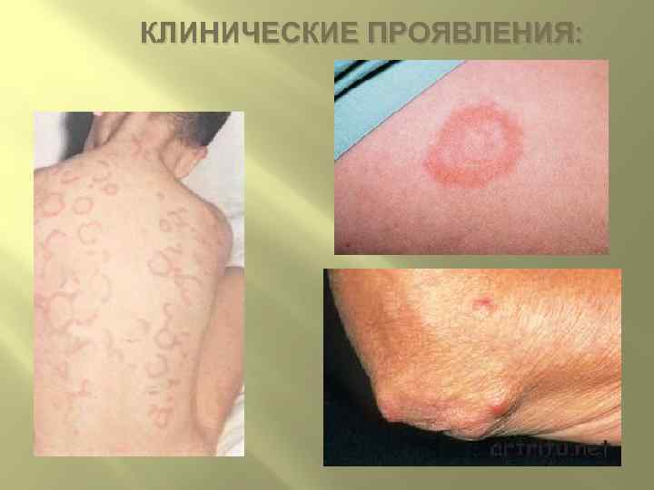 КЛИНИЧЕСКИЕ ПРОЯВЛЕНИЯ: 