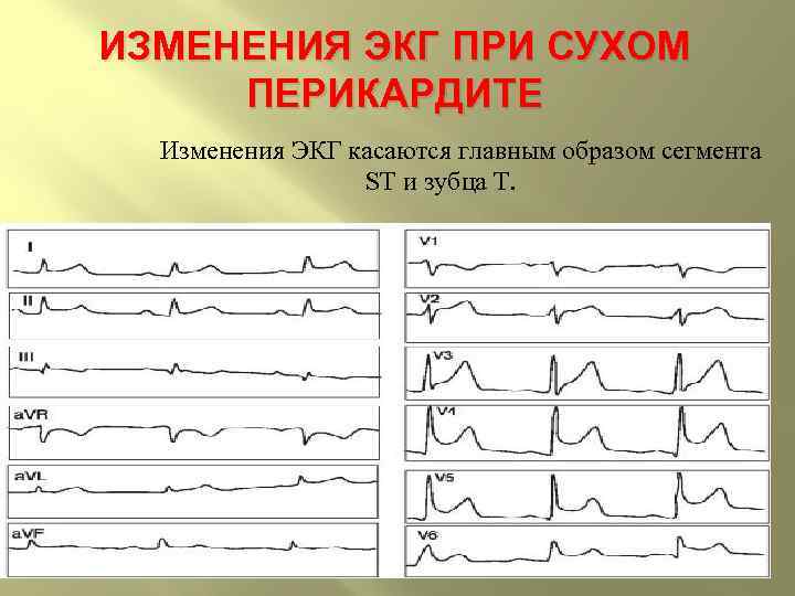 ИЗМЕНЕНИЯ ЭКГ ПРИ СУХОМ ПЕРИКАРДИТЕ Изменения ЭКГ касаются главным образом сегмента ST и зубца