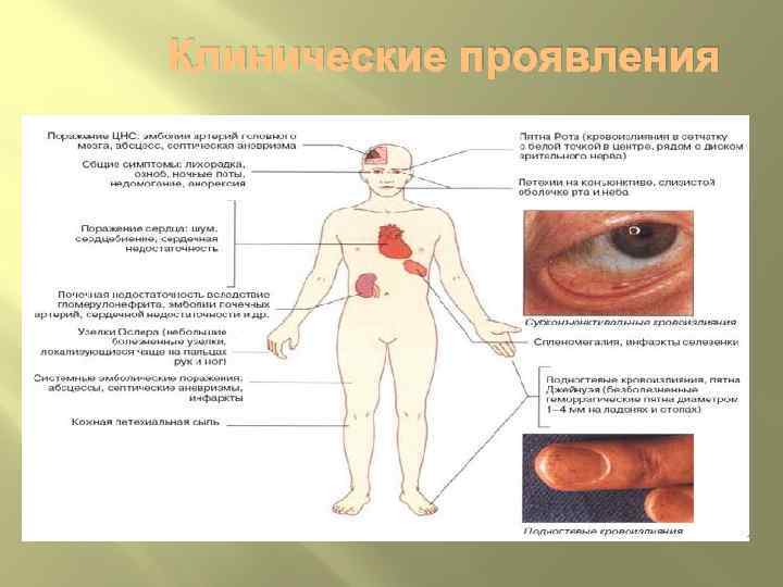 Клинические проявления 