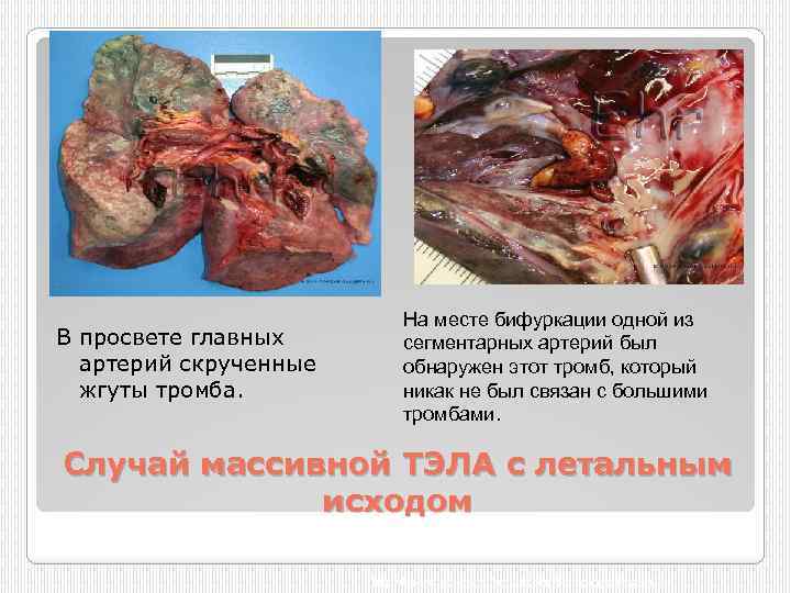 В просвете главных артерий скрученные жгуты тромба. На месте бифуркации одной из сегментарных артерий