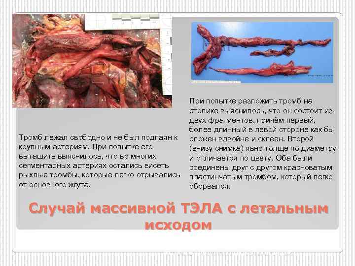Тромб лежал свободно и не был подпаян к крупным артериям. При попытке его вытащить