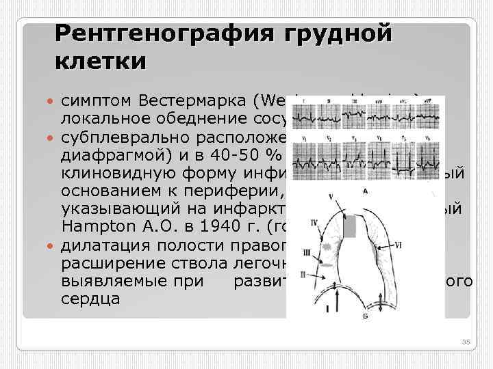 Рентгенография грудной клетки симптом Вестермарка (Westermark's sign) локальное обеднение сосудистого рисунка; субплеврально расположенный (чаще