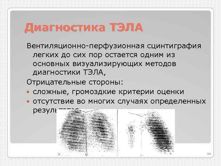 Диагностика ТЭЛА Вентиляционно перфузионная сцинтиграфия легких до сих пор остается одним из основных визуализирующих