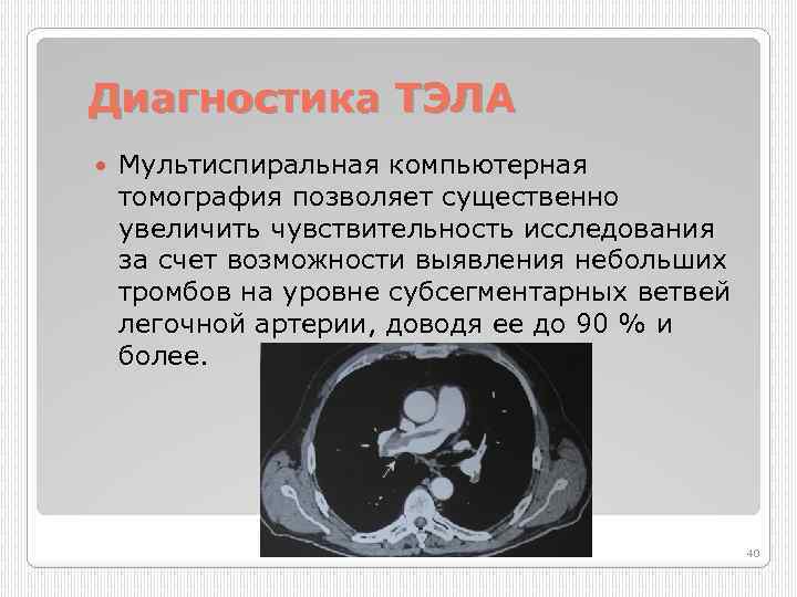 Диагностика ТЭЛА Мультиспиральная компьютерная томография позволяет существенно увеличить чувствительность исследования за счет возможности выявления