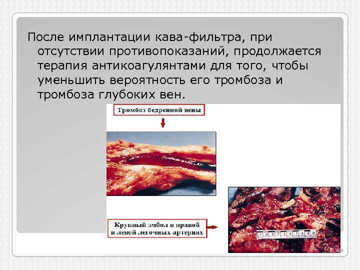 После имплантации кава фильтра, при отсутствии противопоказаний, продолжается терапия антикоагулянтами для того, чтобы уменьшить