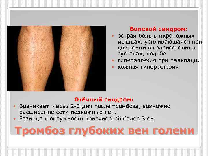 Болевой синдром: острая боль в икроножных мышцах, усиливающаяся при движении в голеностопных суставах, ходьбе