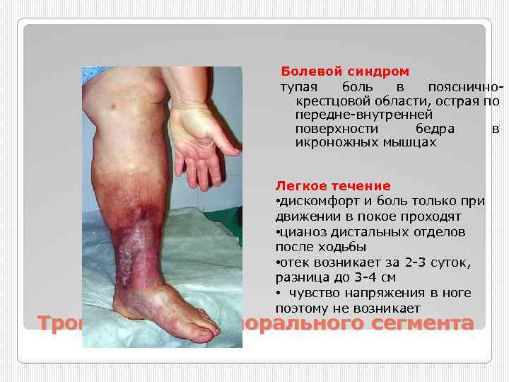 Болевой синдром тупая боль в пояснично крестцовой области, острая по передне внутренней поверхности бедра