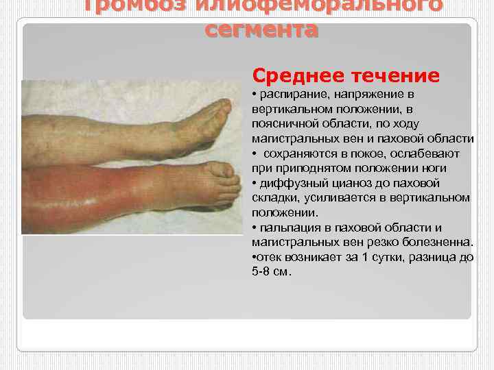Тромбоз илиофеморального сегмента Среднее течение • распирание, напряжение в вертикальном положении, в поясничной области,
