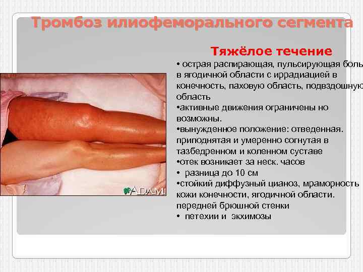 Тромбоз илиофеморального сегмента Тяжёлое течение • острая распирающая, пульсирующая боль в ягодичной области с