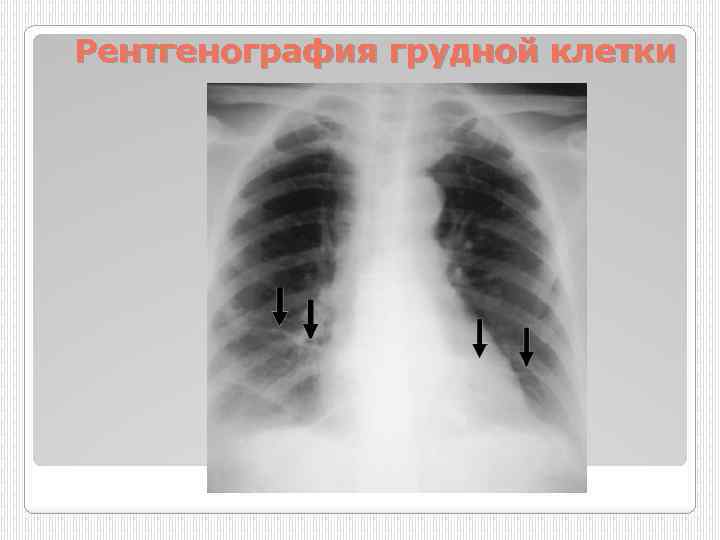 Рентгенография грудной клетки 