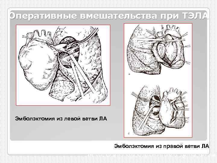 Оперативные вмешательства при ТЭЛА Эмболэктомия из левой ветви ЛА Эмболэктомия из правой ветви ЛА