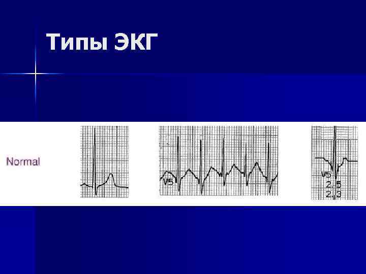 Типы ЭКГ 