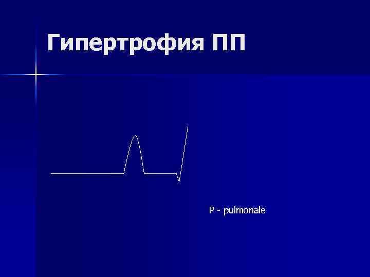 Гипертрофия ПП Р - pulmonale 