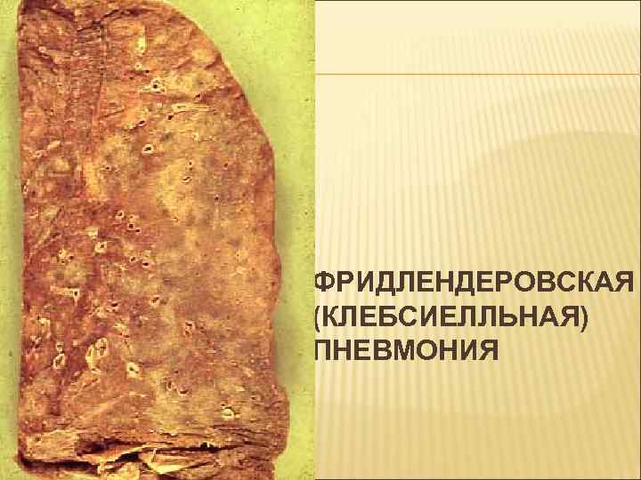ФРИДЛЕНДЕРОВСКАЯ (КЛЕБСИЕЛЛЬНАЯ) ПНЕВМОНИЯ 