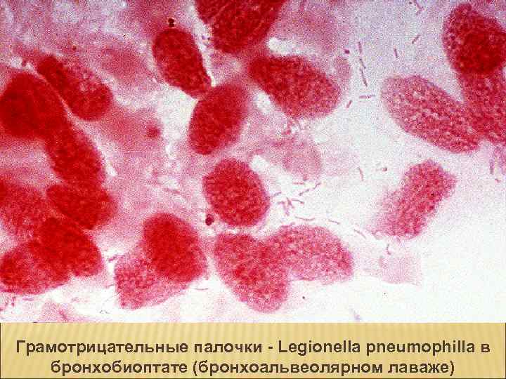 Грамотрицательные палочки - Legionella pneumophilla в бронхобиоптате (бронхоальвеолярном лаваже) 